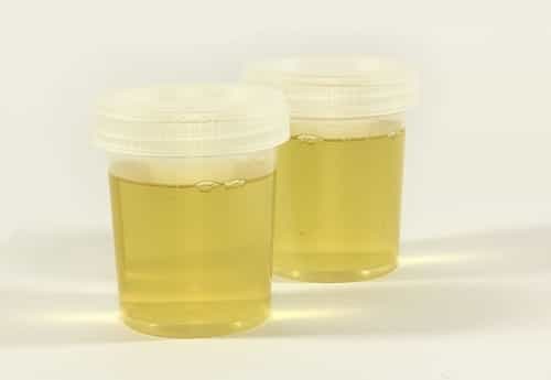 Squamous epithelial cells in urine