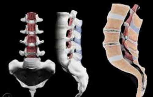 MRI for kissing spine