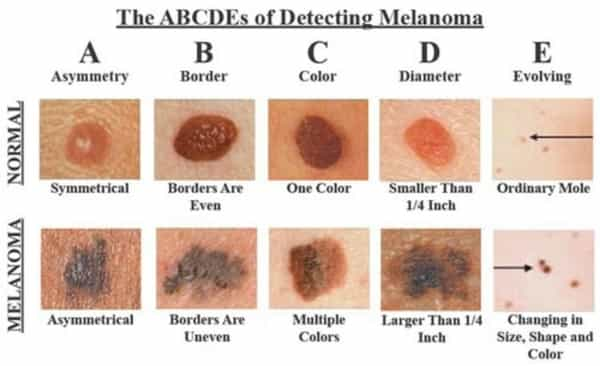 Pictures of difference between normal and cancerous moles