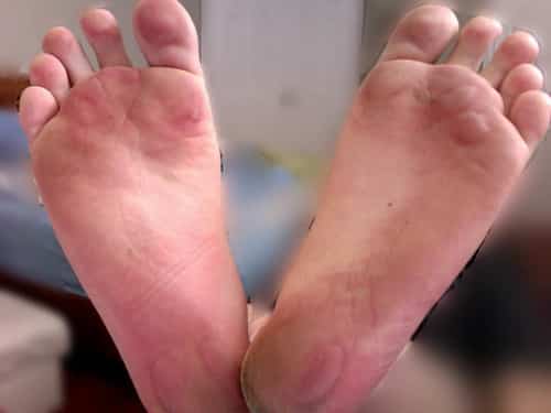 blisters on bottom of foot