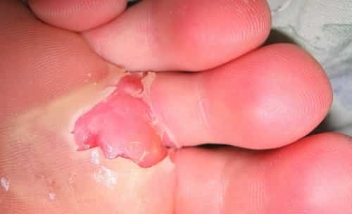 open blister on bottom of foot