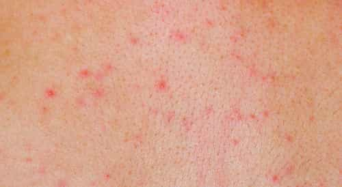 why-do-i-have-red-spots-on-my-chest-design-talk