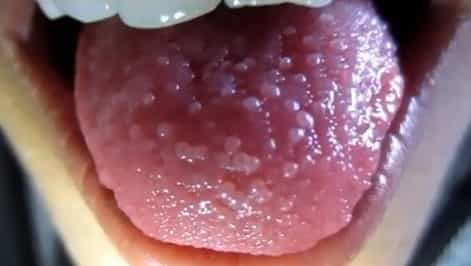 Sore or painful bumps on tongue
