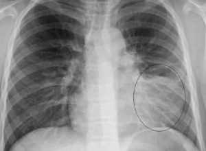 Painful Pleurisy | Health Recovery Tips