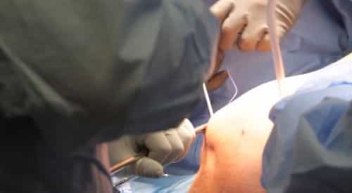 Pain during Rotator Cuff Surgery