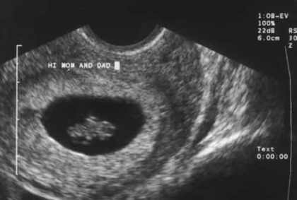 8 Week Pregnancy Ultrasound - IYTmed.com