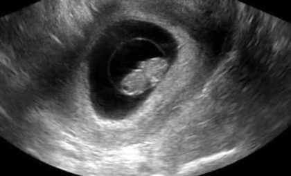 early pregnancy 8 weeks ultrasound