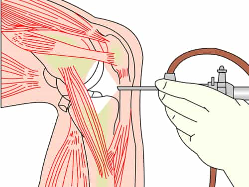 What Causes Shooting Pain In My Knee