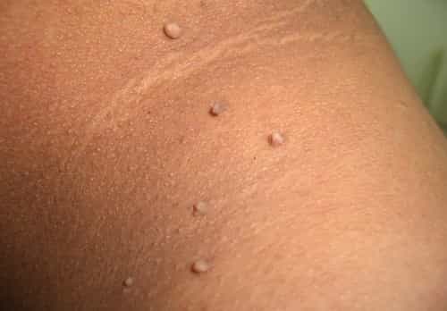 Skin Tags and Cancer