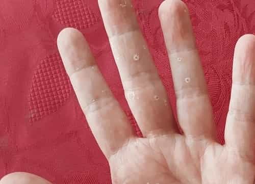 Skin to Peel From Fingertips