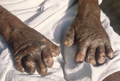 Hansen's disease (Leprosy)