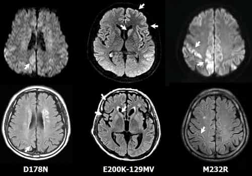 Creutzfeldt-Jakob Disease MRI Image