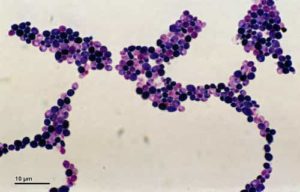 candidiasis vaginal