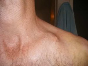 lump collarbone below under causes bone collar iytmed