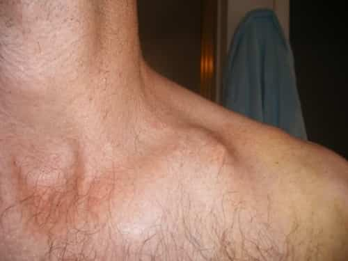 36 Lump Below Collarbone 