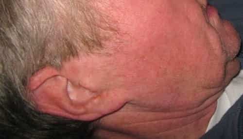 pimple in ear canal