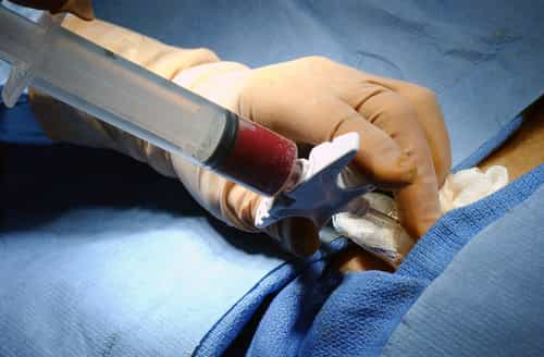 Bone Marrow Transplants