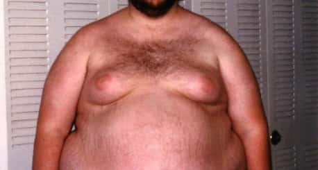 Gynecomastia is swelling of the breast tissue in boys or men, caused by an imbalance of the hormones estrogen and testosterone. Gynecomastia can affect one or both breasts.