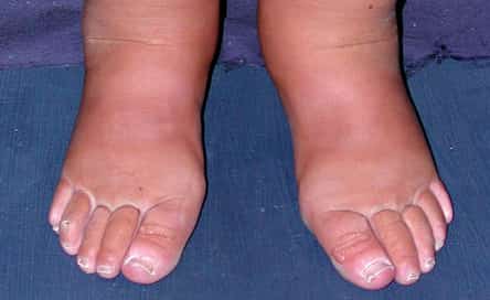 Swelling in your feet and ankles is called edema, and there are a lot of things that can cause the problem, from high blood pressure to pregnancy.