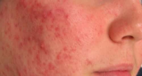 Woman has red spots on cheeks