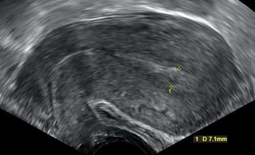 5 week old fetus miscarriage