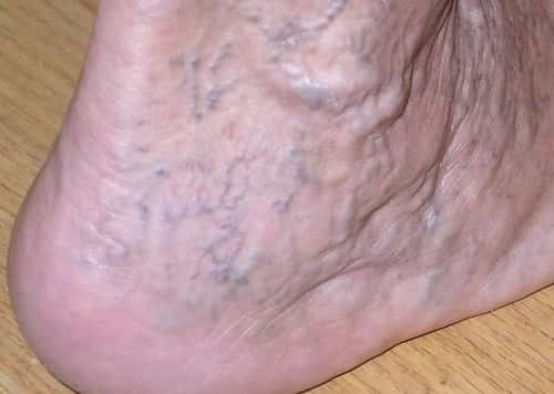 symptoms-and-warning-signs-of-blood-clots-in-leg-iytmed