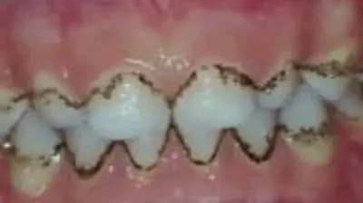 removing black deposits on teeth