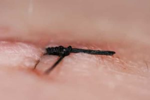 How Long Does It Take for Stitches to Dissolve? - IYTmed.com