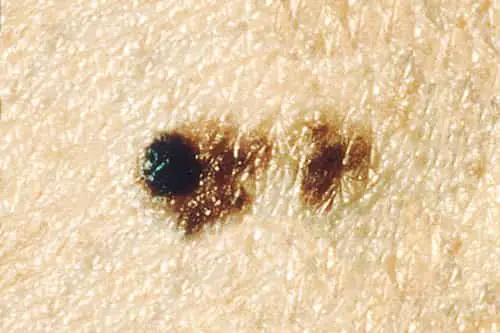 Moles are skin growths made up of cells that produce color (pigment). A mole can appear anywhere on the skin, alone or in groups.
