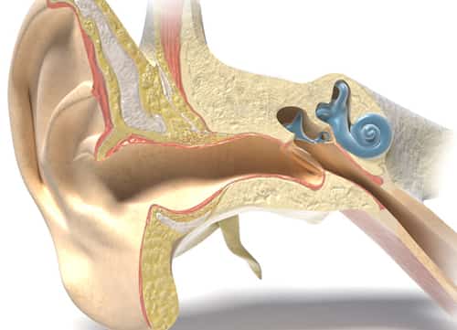 Swimmer's ear, or external otitis, is typically a bacterial infection of the skin of the outer ear canal. In contrast to a middle ear infection, swimmer's ear is an infection of the outer ear.