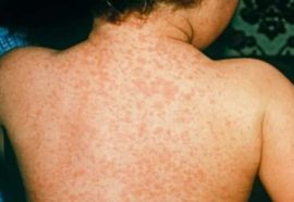 Identifying Meningitis Rash Meningitis Rashes: How to Recognize the Disease (with Pictures)?