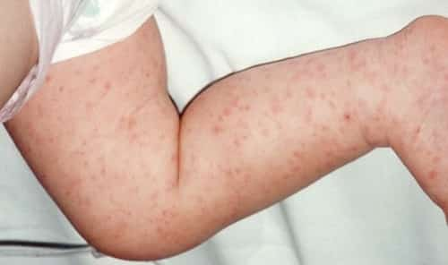 meningitis rashes on baby leg