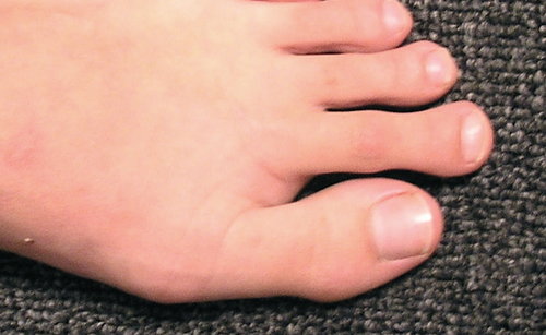 The symptoms of predislocation syndrome often include swelling and warmth under the base of the 2nd toe.