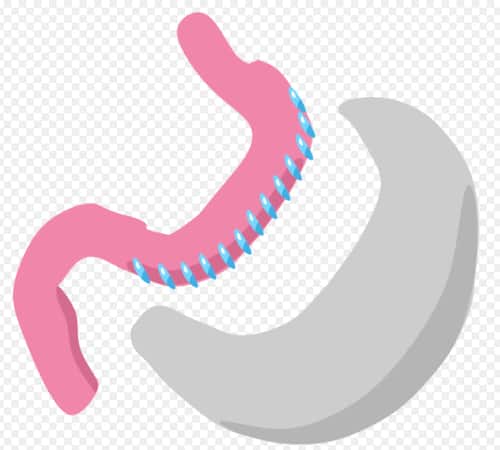 The sleeve gastrectomy involves removal of at least 75% of the stomach. This reduces the volume capacity of the stomach to fight morbid obesity.