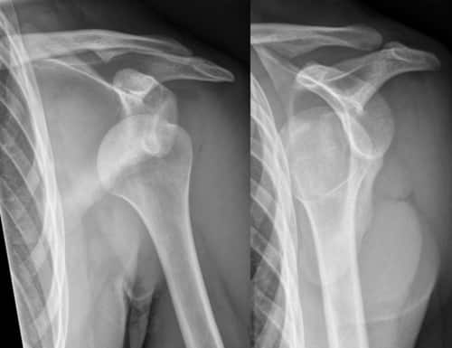 The shoulder is one of the easiest joints to dislocate because the ball joint of your upper arm sits in a very shallow socket.