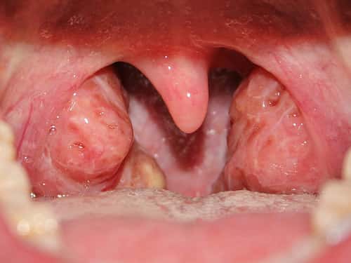 The most common cause of a pus in tonsils is an infection. Infections may be due to bacteria, a fungus, or a virus. Treatments vary, but gargling warm salt water several times a day may help ease the symtoms.