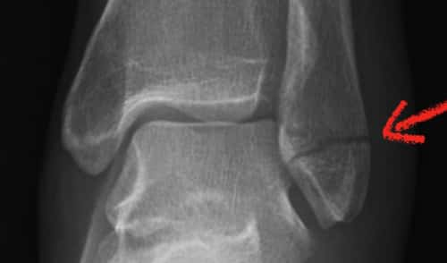 closed nondisplaced fracture of lateral malleolus of left fibula