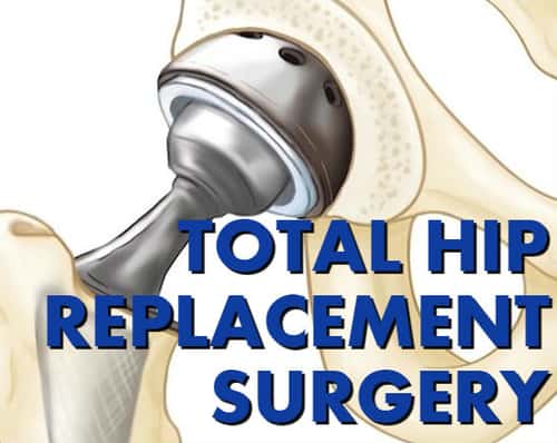 Life Expectancy After Total Hip Replacement