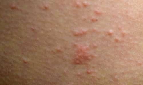 There are many over the counter creams and lotions available in the market which can kill the scabies mite. Permethrin is the major ingredient in most of the scabies treatment creams.