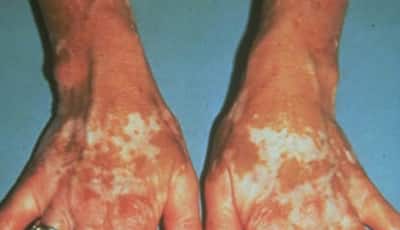 Liver spots are medically termed ‘Lentigos” and also known as age spots. They are sharply defined white (light brown) to black flat patches of skin that appear on the face, back of the hands and other areas of the body.
