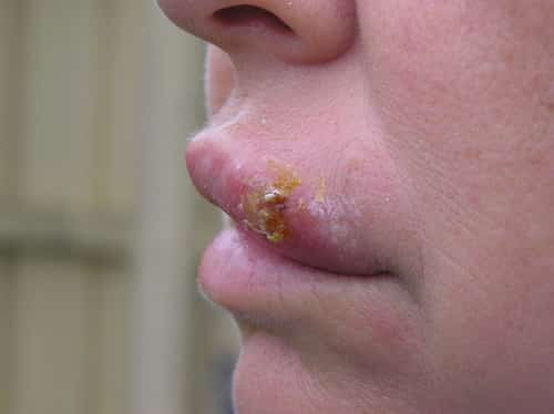 8 Herpes On Lips Health Recovery Tips