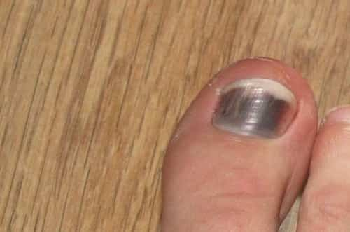 bruise-under-toenail-won-t-go-away-iytmed