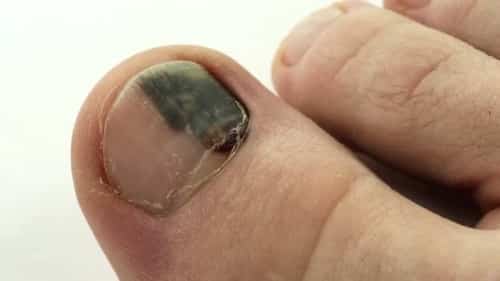 Well, bruised toenail will definitely go away over time but form that you have to do something.