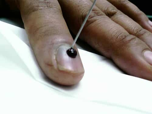 Needle used to remove dark spot from under the nail