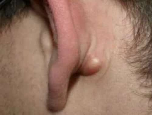 Lump behind woman's ear