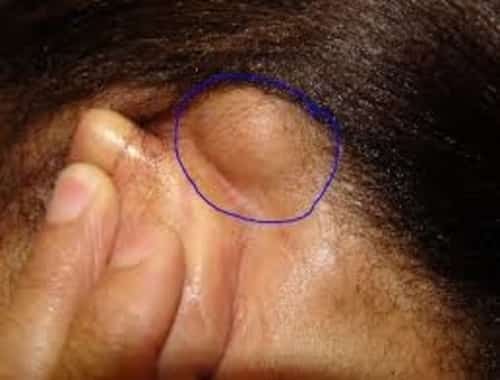 Generally, most lumps are caused by non-cancerous (benign) conditions. A painless lump behind the ear can be big or small in size, and it can go unnoticed for days or weeks.