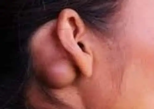 Huge bump behing an ear