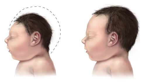 zika and microcephaly 