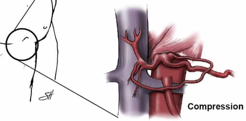 Patients with MALS reportedly experience abdominal pain, particularly in the epigastrium, which may be associated with eating and which may result in anorexia and weight loss.