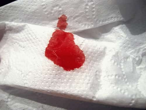 Hemorrhoidal tissue bleeding non-stop